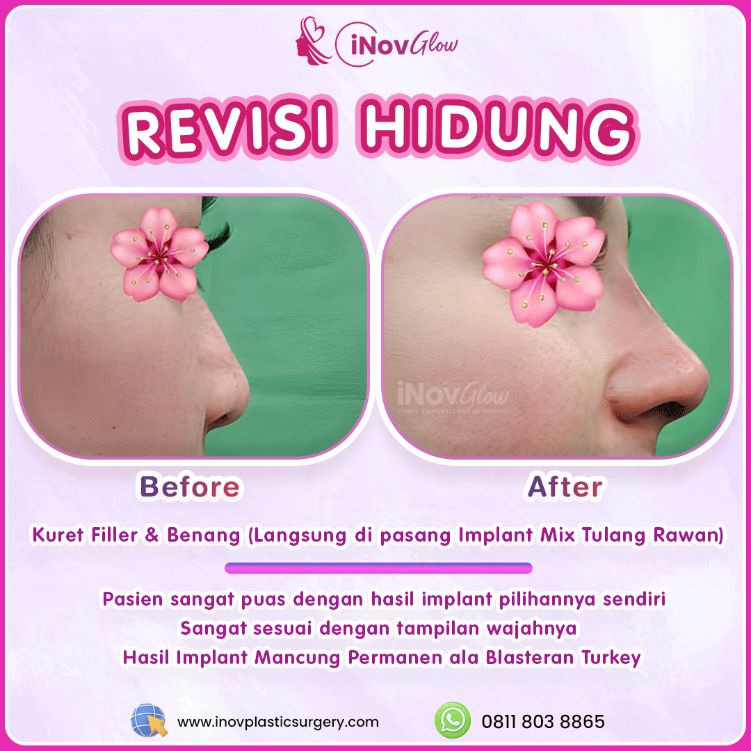 Revisi-Hidung-InovGlow-Feed-002.png