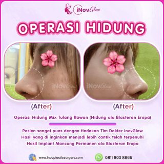 Operasi Hidung Blasteran di Jakarta