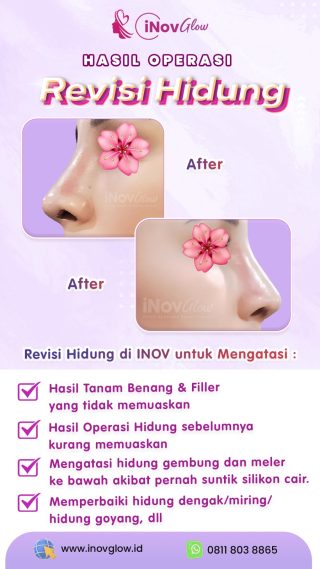 Revisi Hidung di Jakarta