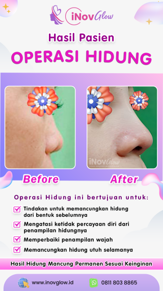 Rhinoplasty di Klinik Inov Glow: Solusi Operasi Memancungkan Hidung