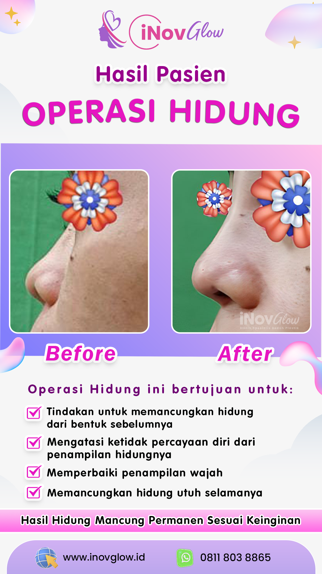 Operasi-Hidung-InovGlow-IGS-Juni-002.png