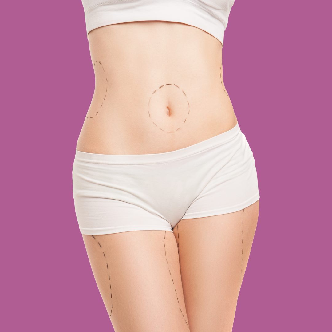 Sedot-Lemak-Mini-Tummy-Tuck-fotor-20230711185024.jpg