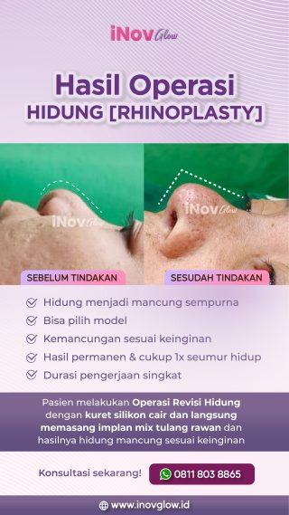 Operasi Hidung Mancung di Jakarta