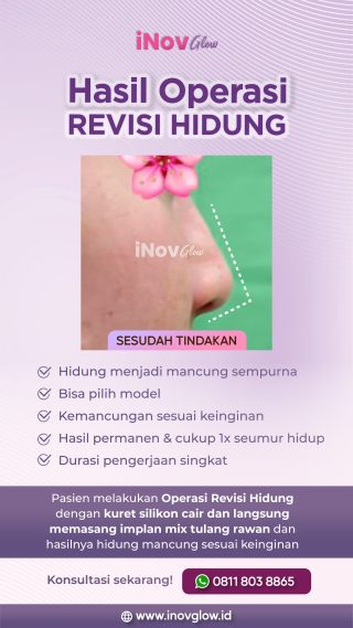 Revisi Hidung