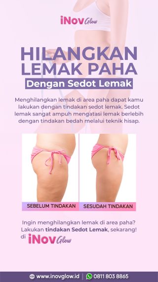 Perawatan Slimming yang Bikin Ramping dengan Liposuction