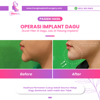 Operasi Genioplasty: Menciptakan Kesempurnaan Profil Wajah