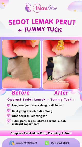 Operasi Sedot Lemak dan Tummy Tuck untuk Perubahan Tubuh