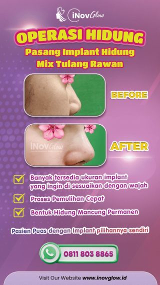 Hidung Mancung Impian Bersama Inov Glow