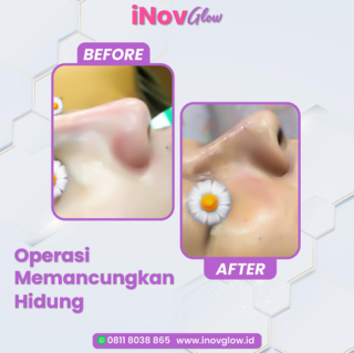 Operasi Hidung Mancung di Jakarta