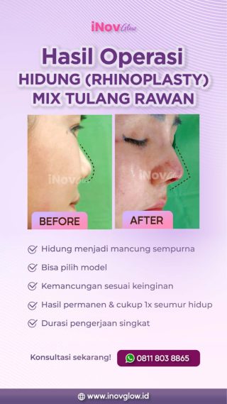 Memiliki Hidung Mancung Idaman: Keahlian Rhinoplasty di Inov Glow