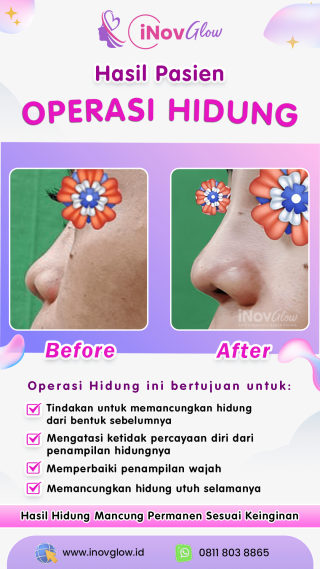 Rhinoplasty di Klinik Inov Glow: Solusi Operasi Memancungkan Hidung