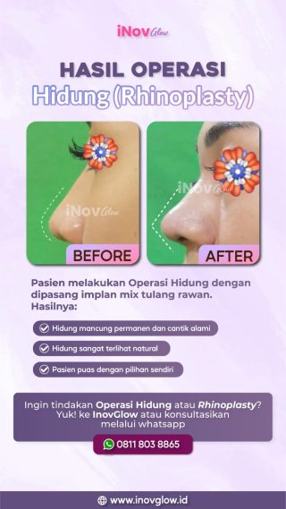 Manfaat Operasi Hidung di Inov Glow