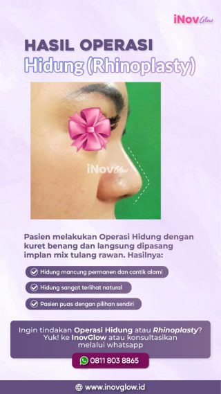 Operasi Plastik Hidung Mancung di Inov Glow