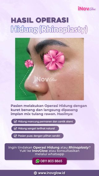 Operasi Plastik Hidung Mancung di Inov Glow