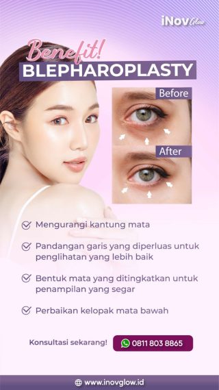 Blepharoplasty di Jakarta