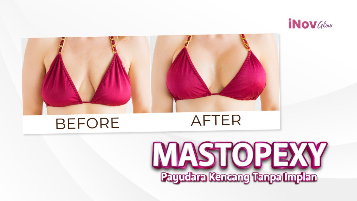 28-November_BEFORE-AFTER-MASTOPEXY-1200x675.jpg