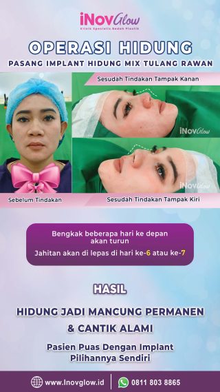 InovGlow Klinik Operasi Hidung Mancung Yang Mengutamakan Keselamatan Dan Kecantikan Estetika Anda