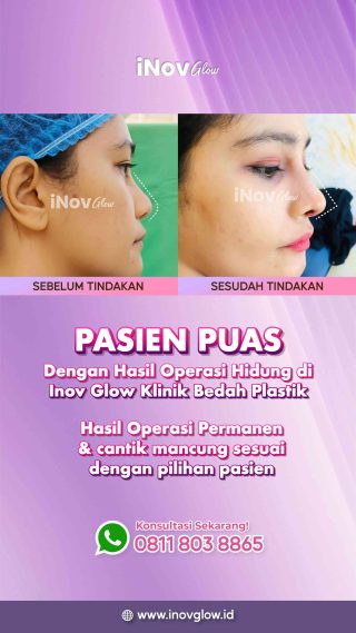 Mengenal Rahasia di Balik Operasi Hidung atau Rhinoplasty di Klinik Inov Glow