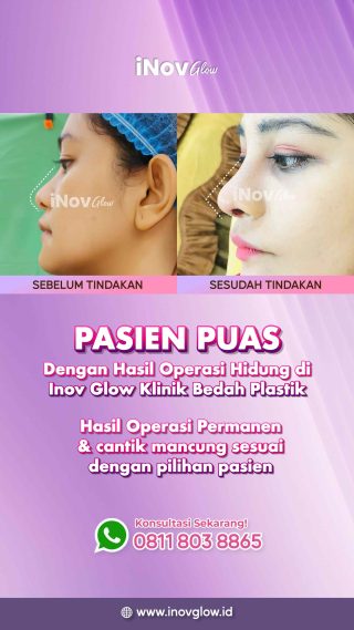 Memahami Manfaat Operasi Hidung di Klinik Inov Glow