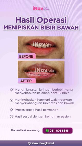 31 JULY_HASIL OP MENIPISKAN BIBIR BAWAH-fotor-20240320162013