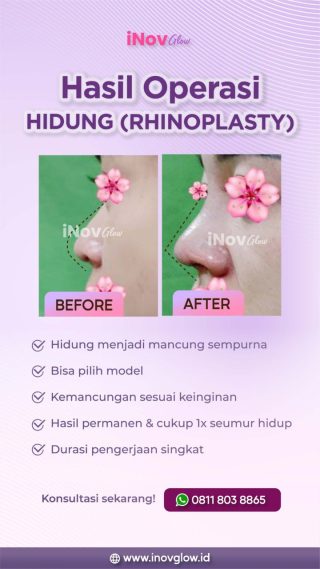 Rhinoplasty: Prosedur Operasi Hidung yang Dilakukan di Klinik Inov Glow