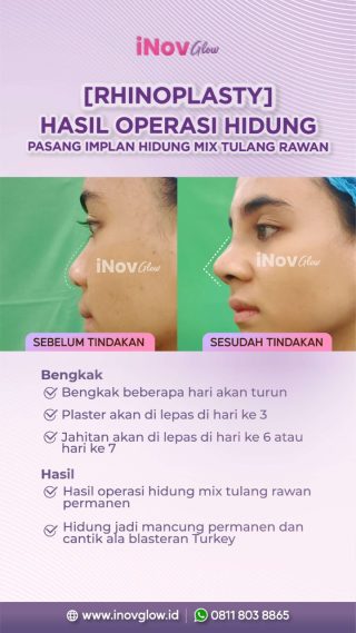 Keunggulan Klinik Inov Glow dalam Melakukan Rhinoplasty