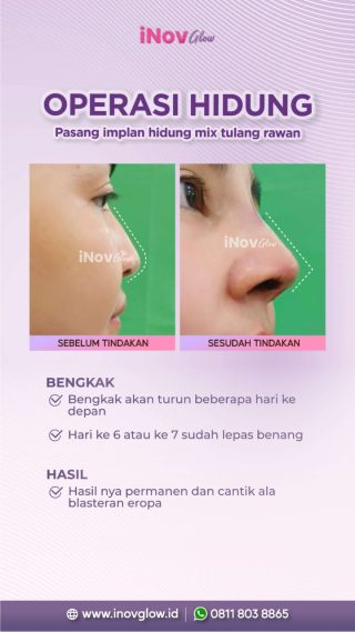 Membangun Rasa Percaya Diri dengan Operasi Hidung di Klinik Inov Glow