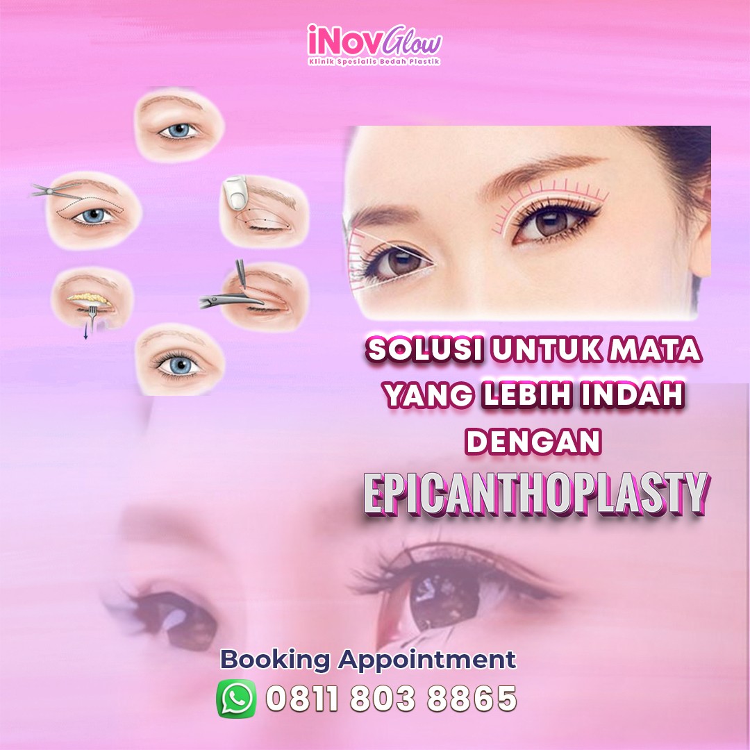 Solusi-untuk-mata-lebih-indah-dengan-Epicanthoplasty-fotor-20240605134558.jpg